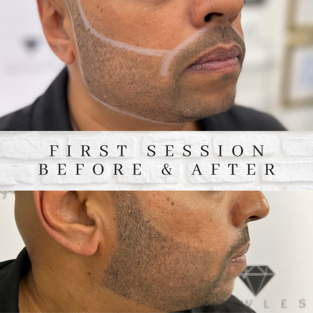 beard tattoo beard micropigmentation