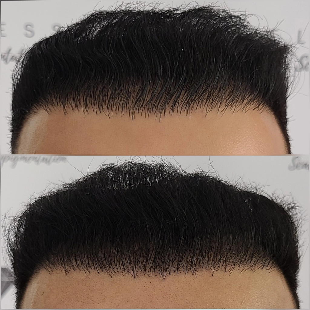 hair transplant density Vancouvers best smp artist Hair loss tattoo