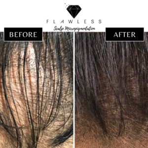 Flawless Scalp Micropigmentation before and after SMP Best Scalp Micropigmentation Artist Vancouver SMP