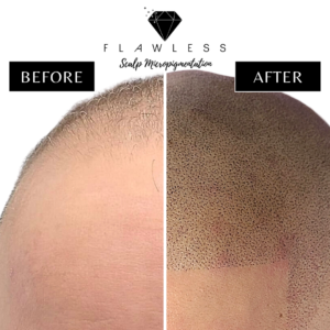 Flawless Scalp Micropigmentation before and after SMP Best Scalp Micropigmentation Artist Vancouver SMP