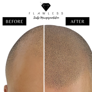 Flawless Scalp Micropigmentation before and after SMP Best Scalp Micropigmentation Artist Vancouver SMP