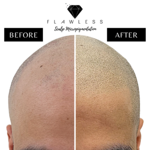 Flawless Scalp Micropigmentation before and after SMP Best Scalp Micropigmentation Artist Vancouver SMP