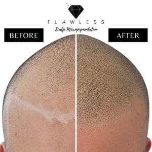 Flawless Scalp Micropigmentation before and after SMP Best Scalp Micropigmentation Artist Vancouver SMP
