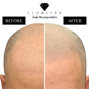 Flawless Scalp Micropigmentation before and after SMP Best Scalp Micropigmentation Artist Vancouver SMP