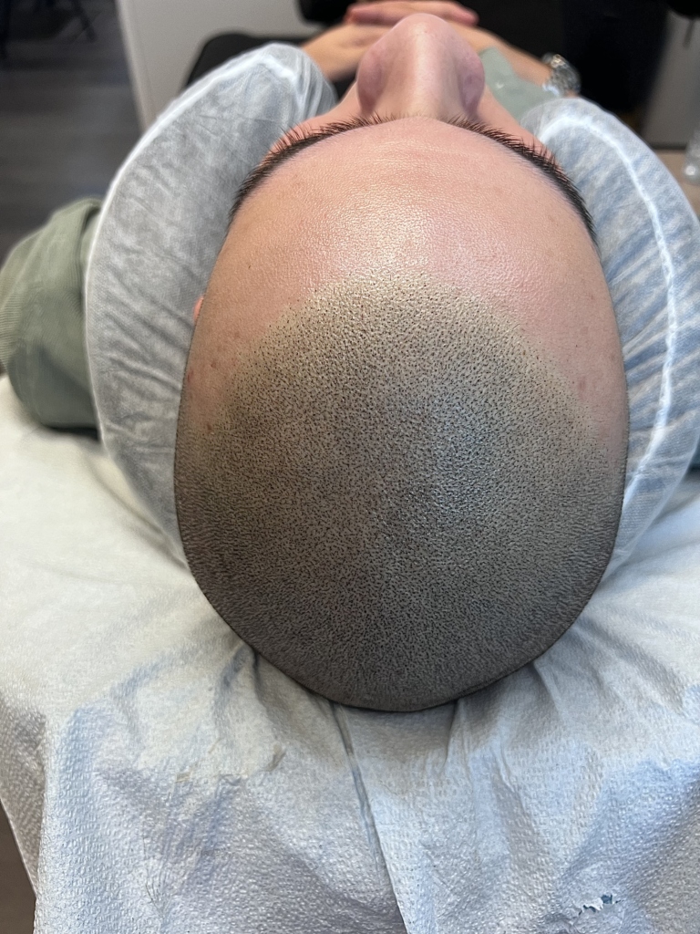 Scalp micropigmentation by Donna Fathi Flawless SMP Vancouver Artist