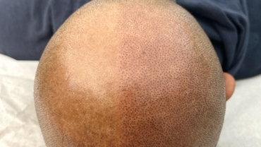 Flawless Scalp Micropigmentation before and after SMP Best Scalp Micropigmentation Artist Vancouver SMP