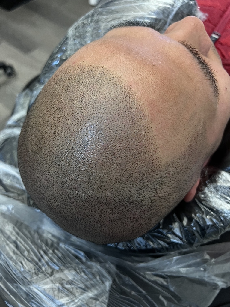 Flawless Scalp Micropigmentation before and after SMP Best Scalp Micropigmentation Artist Vancouver SMP