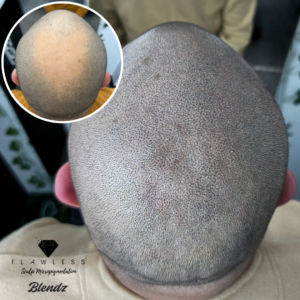 Best SMP artist in Vancouver - Donna Fathi Flawless Scalp Micropigmentation before and after SMP Best Scalp Micropigmentation Artist Vancouver SMP