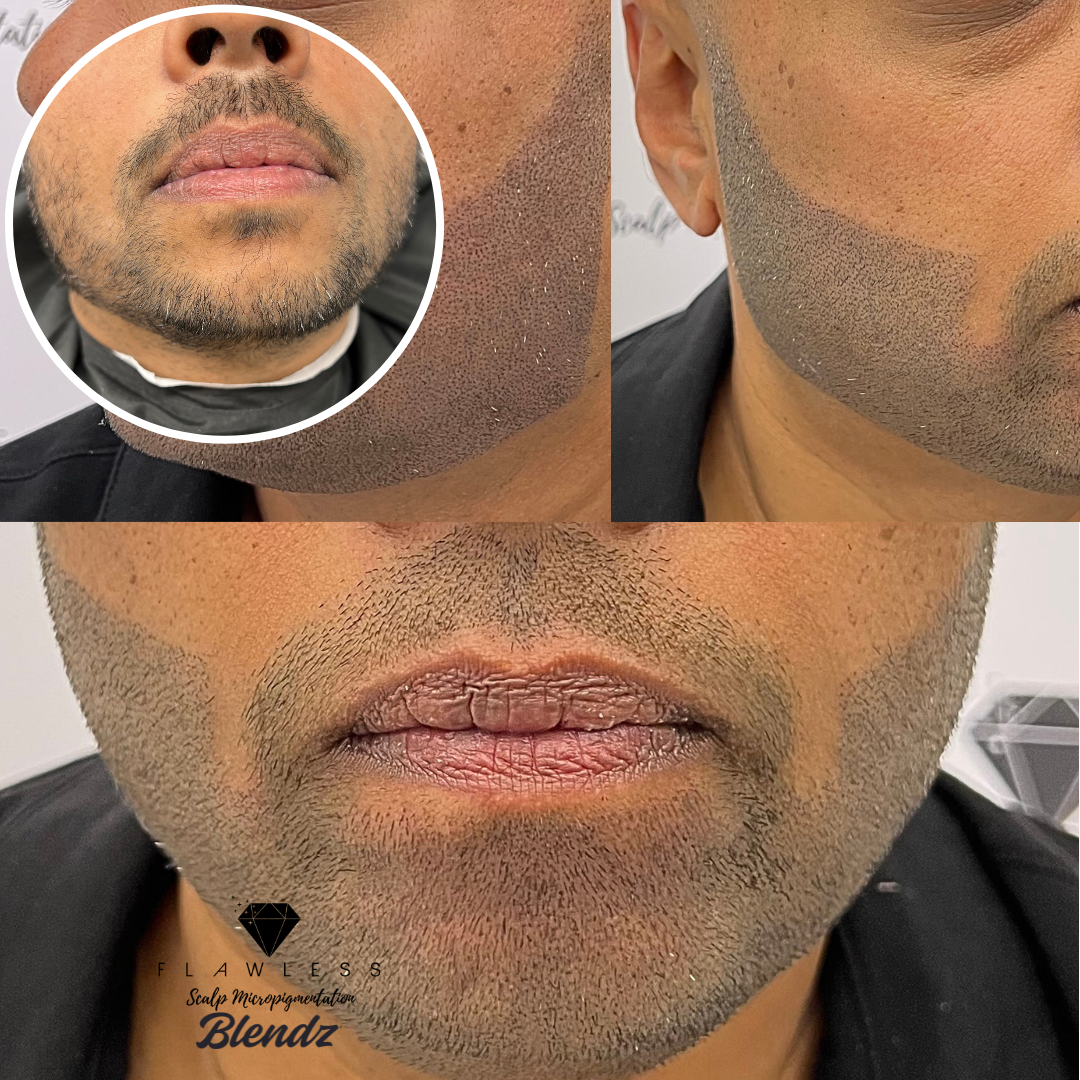 before and after beard facial micropigmentation by flawless smp Flawless Scalp Micropigmentation before and after SMP Best Scalp Micropigmentation Artist Vancouver SMP