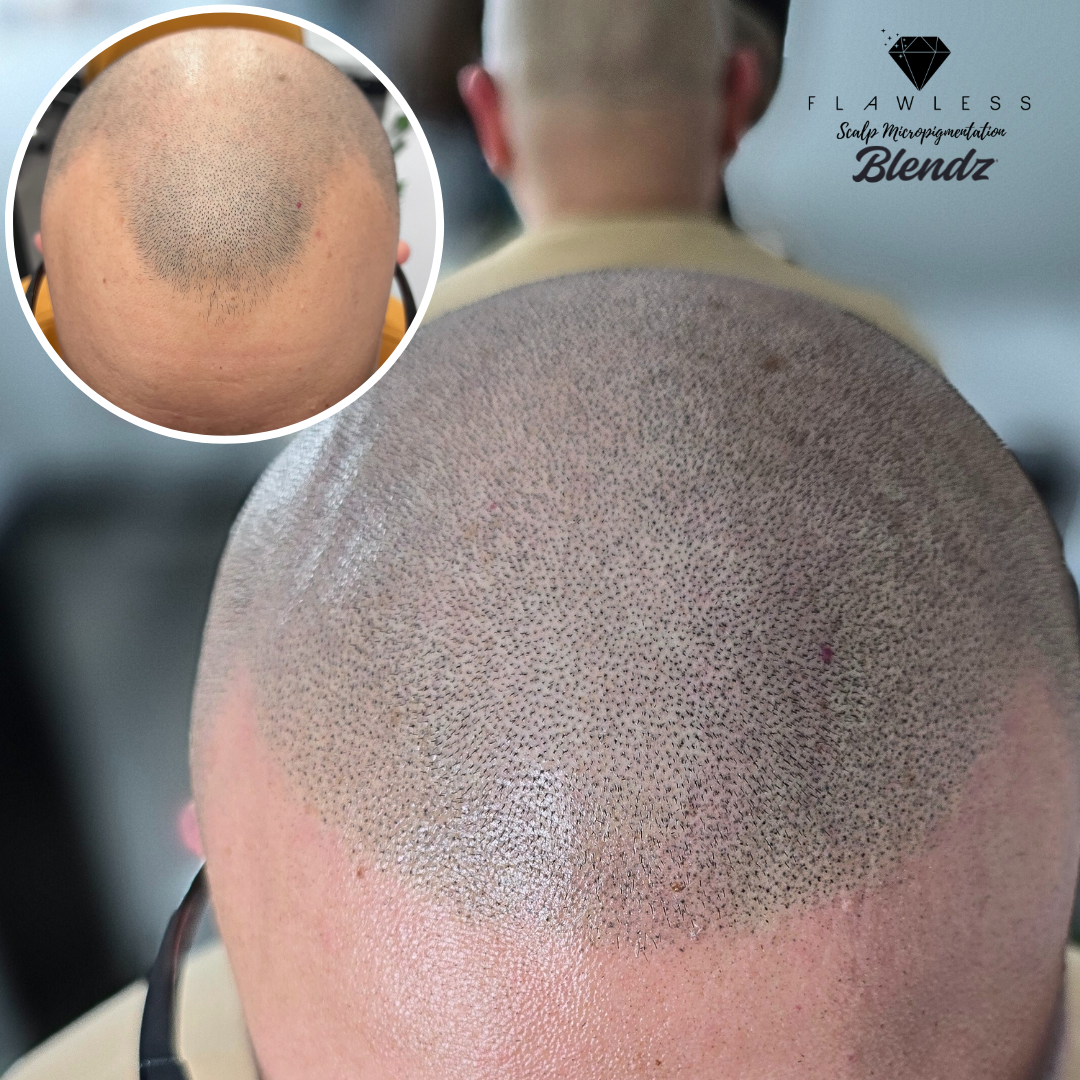 Flawless Scalp Micropigmentation before and after SMP