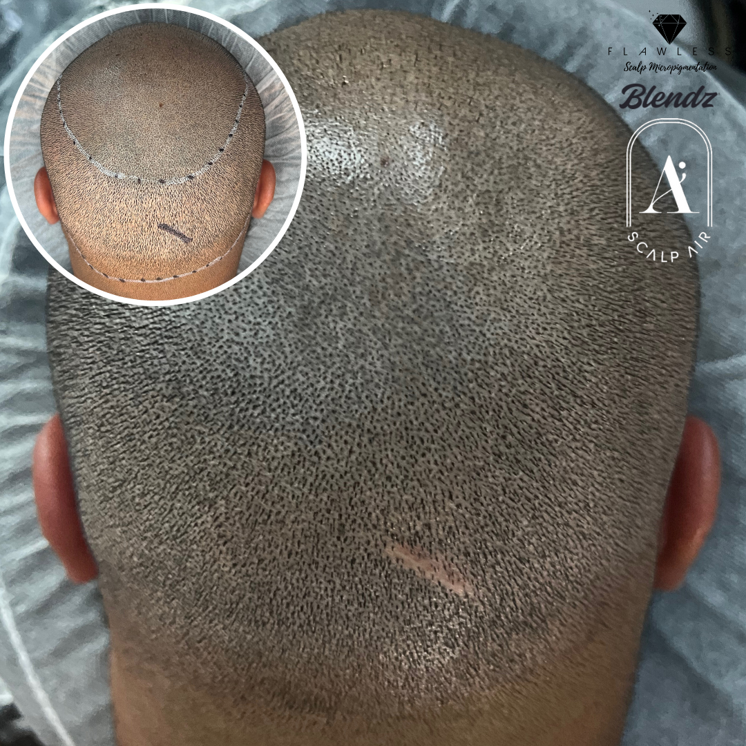 Scalp Micropigmentation Scar Cover up by flawless smp Flawless Scalp Micropigmentation before and after SMP Best Scalp Micropigmentation Artist Vancouver SMP