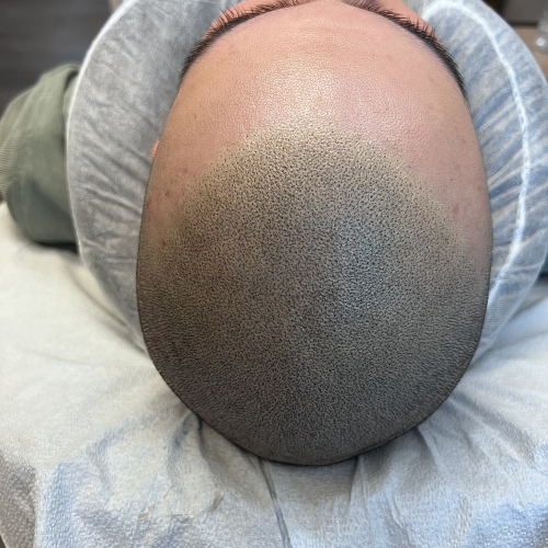 Scalp micropigmentation by Donna Fathi Flawless SMP Vancouver Artist